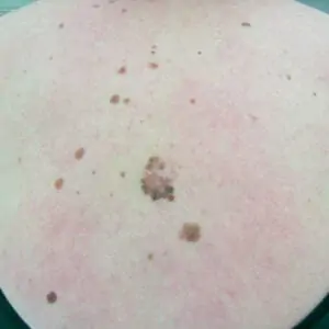 Other treatments - melanoma in the back