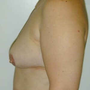 Breast reconstructions - immediate breast reconstruction with ms-TRAM (left breast), left side view