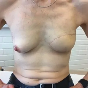 Breast reconstructions - LD 2 years after operation, front view