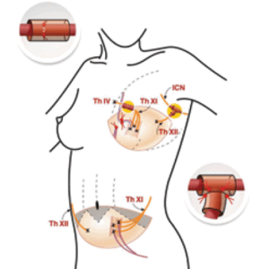 Breast reconstructions - MS TRAM scheme