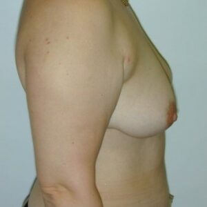 Breast reconstructions - immediate breast reconstruction with ms-TRAM (left breast), right side view