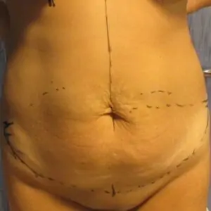 Aesthetic surgery - Abdominoplasty, front, before