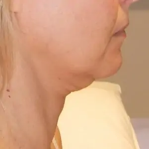 Aesthetic surgery - Face lift, right side, before