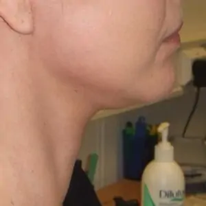 Aesthetic surgery - Face lift, right side, after