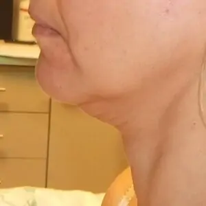 Aesthetic surgery - Face lift, left side, before