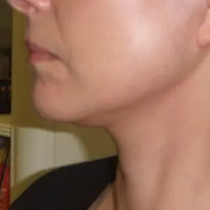 Aesthetic surgery - Face lift, left side, after