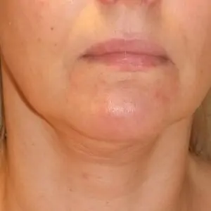 Aesthetic surgery - Face lift, front, before