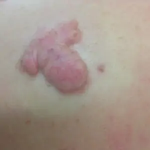 Other treatments - Keloid scar