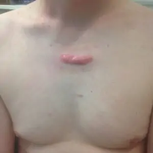 Other treatments - Keloid scar in the chest