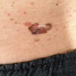 Other treatments - melanoma on the side of the body