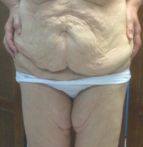 Other treatments - Postbariatric syndrome, frontal preop
