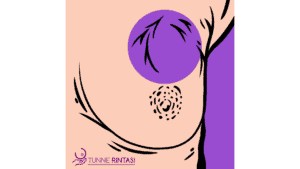 Retraction of the skin of the breast