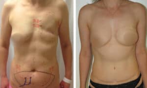 Ennen ja jälkeen -kuvat ms-TRAM-rintarekonstruktiosta tunteva rinta -tekniikalla: vasemmalla leikkausta edeltävä tilanne kirurgisine merkintöineen, oikealla lopputulos.